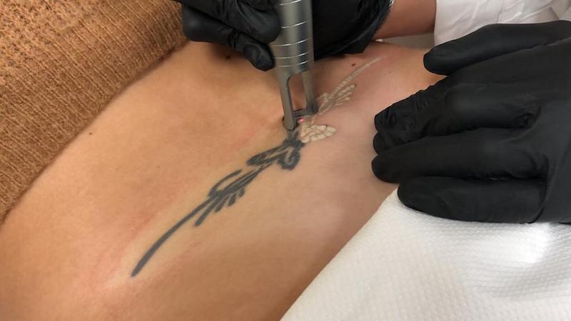 Type de tatouage et durée de détatouage - Detatouage medical